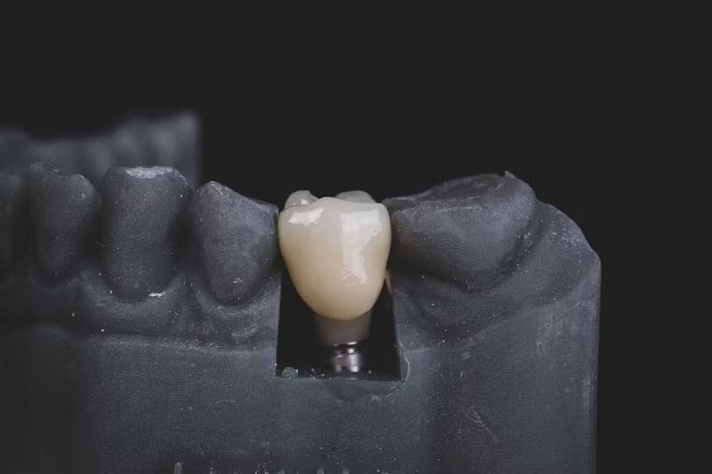 Dental Implants: A Comprehensive Guide